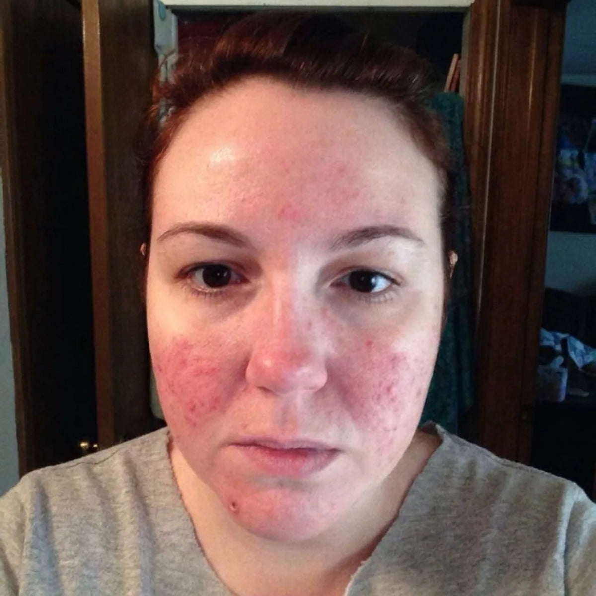 Day 0 - Post Sun